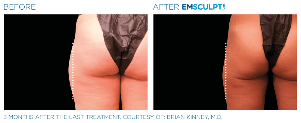Treatment result 28