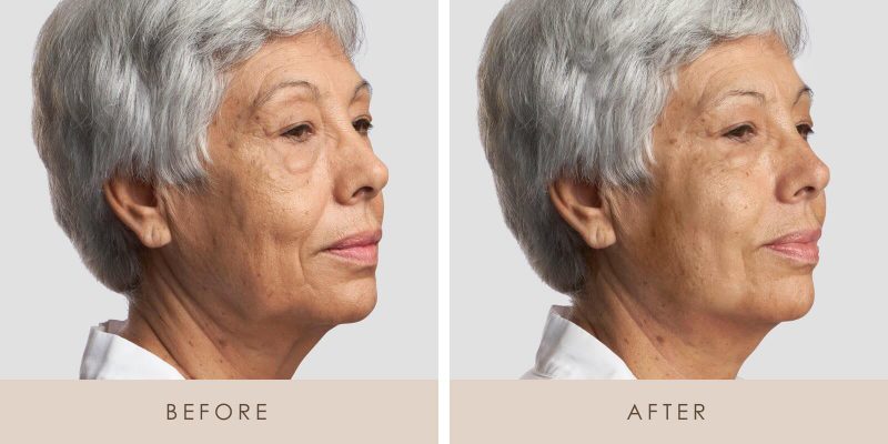 Treatment result 1
