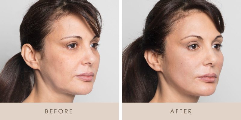 Treatment result 3
