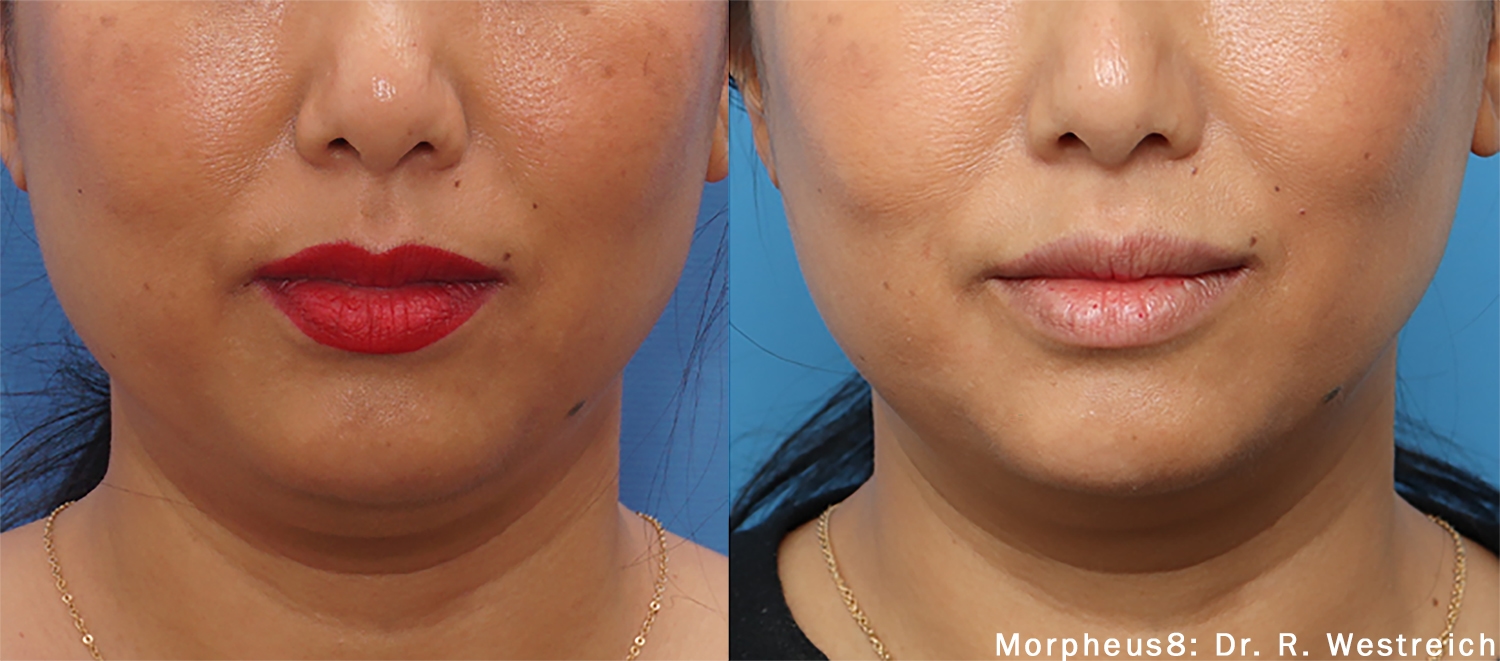 Treatment result 2