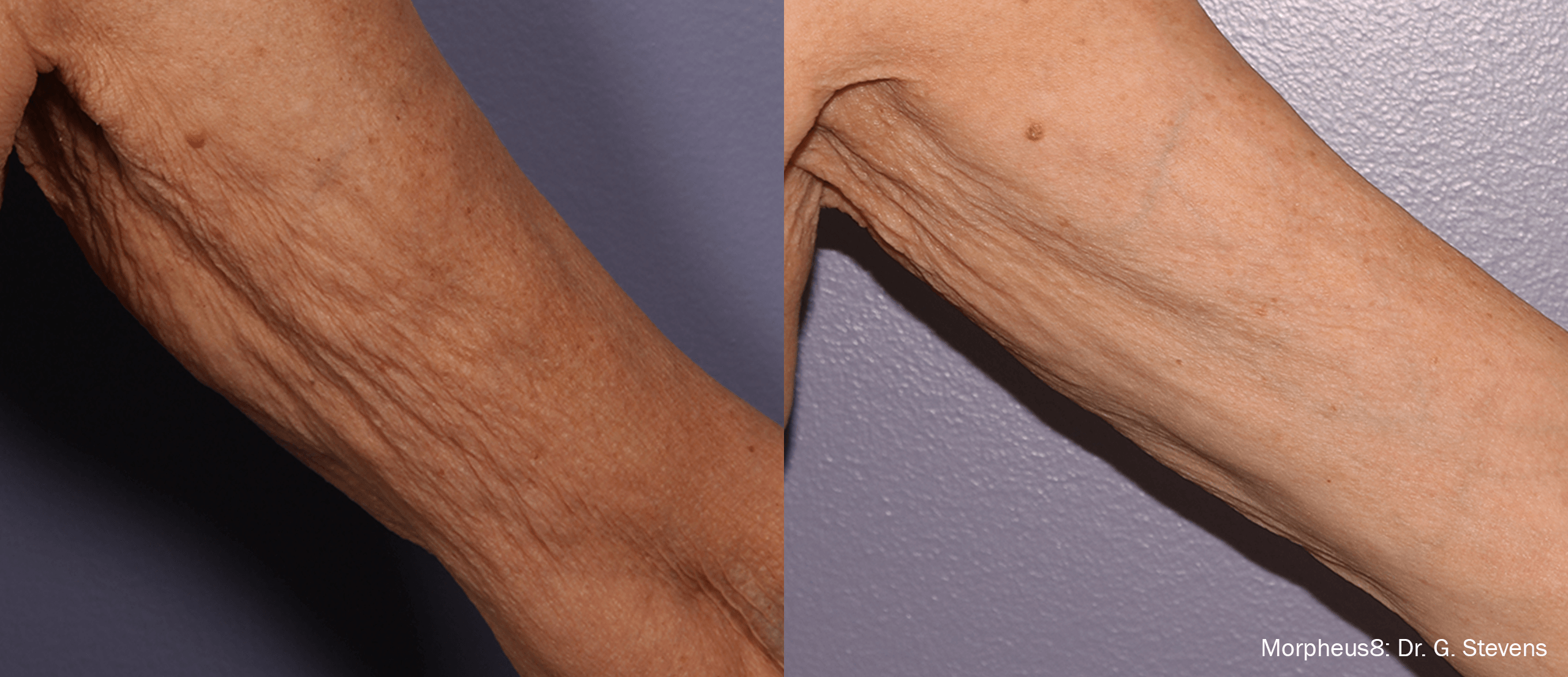 Treatment result 4