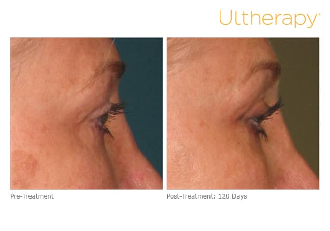 Treatment result 11