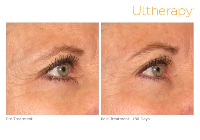 Treatment result 14