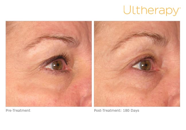 Treatment result 15