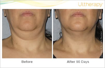 Treatment result 16