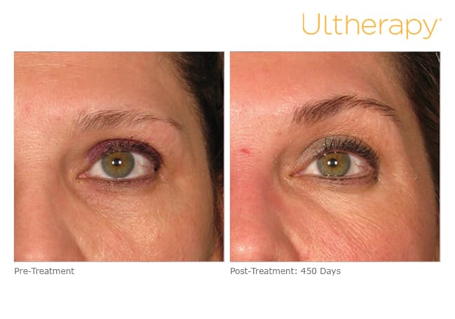 Treatment result 17