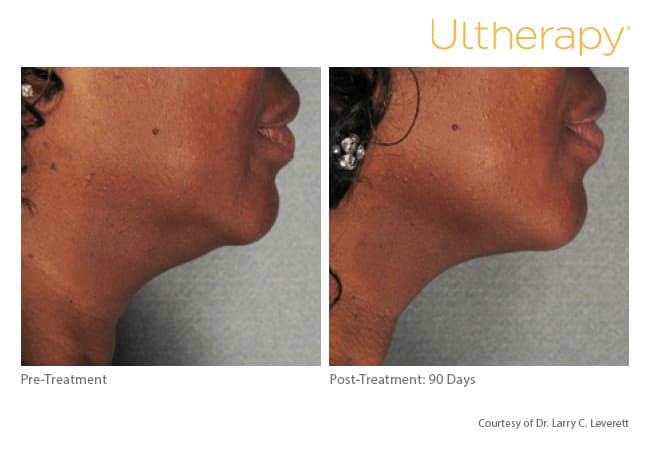 Treatment result 18