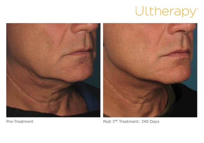 Treatment result 19