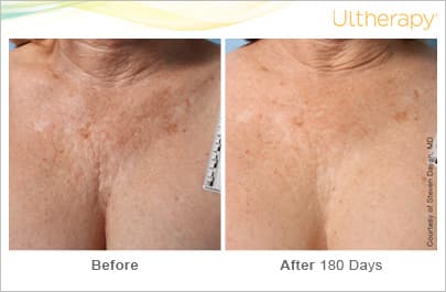Treatment result 2
