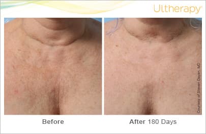 Treatment result 5